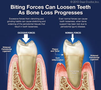 Loose Teeth & Bite Problems