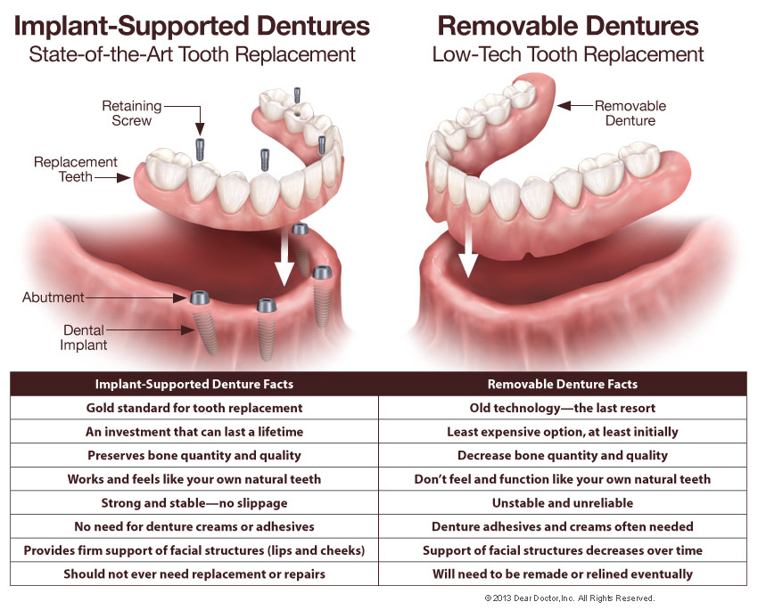 Fixed Dentures